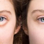 درمان پف زیر چشم