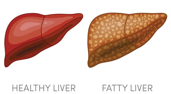 علائم کبد چرب